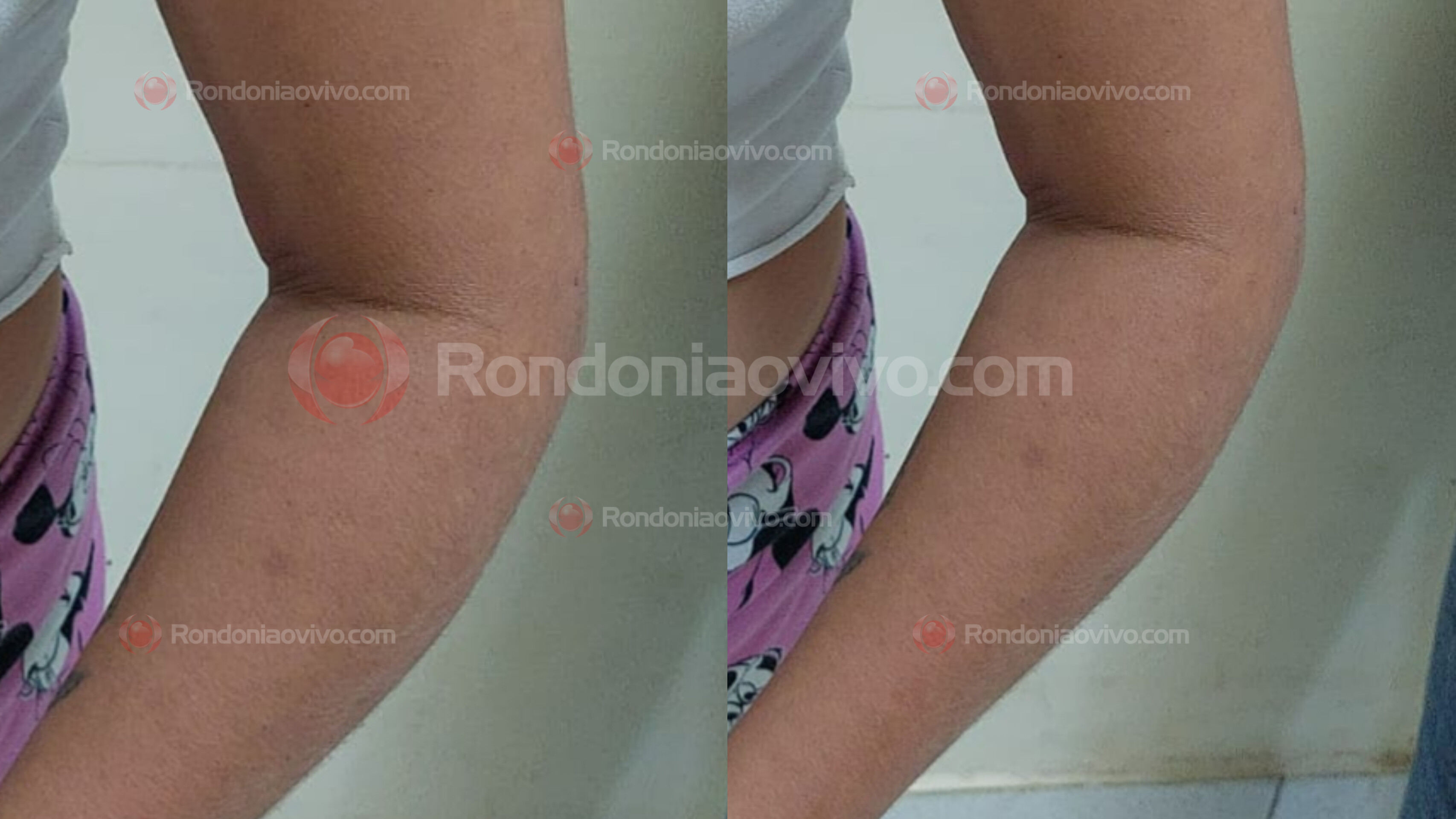 URGENTE: Marido foge após quebrar braço da mulher a pauladas 