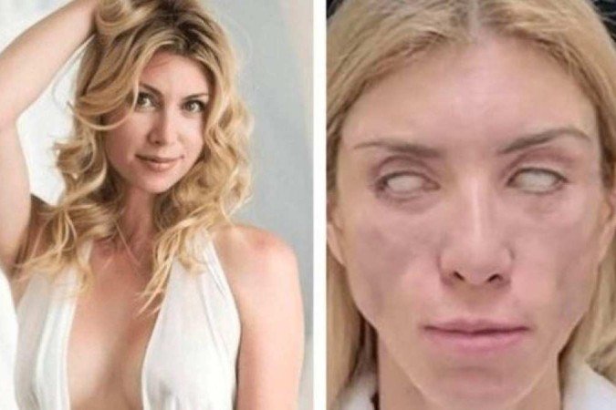 PERIGO: Miss russa afirma não conseguir fechar os olhos após cirurgia plástica