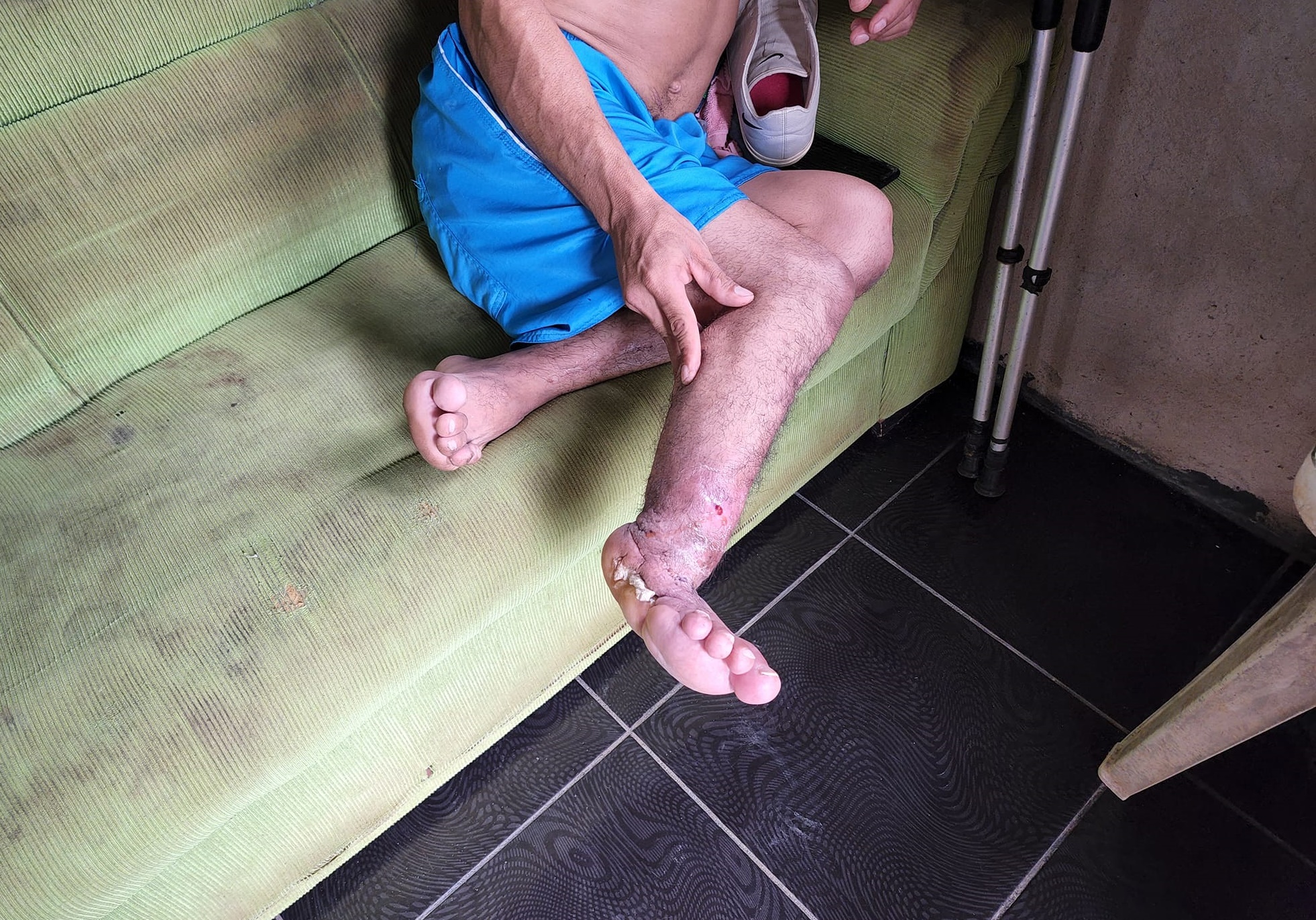 Homem tem o pé necrosado e clama por cirurgia de amputação em Porto Velho