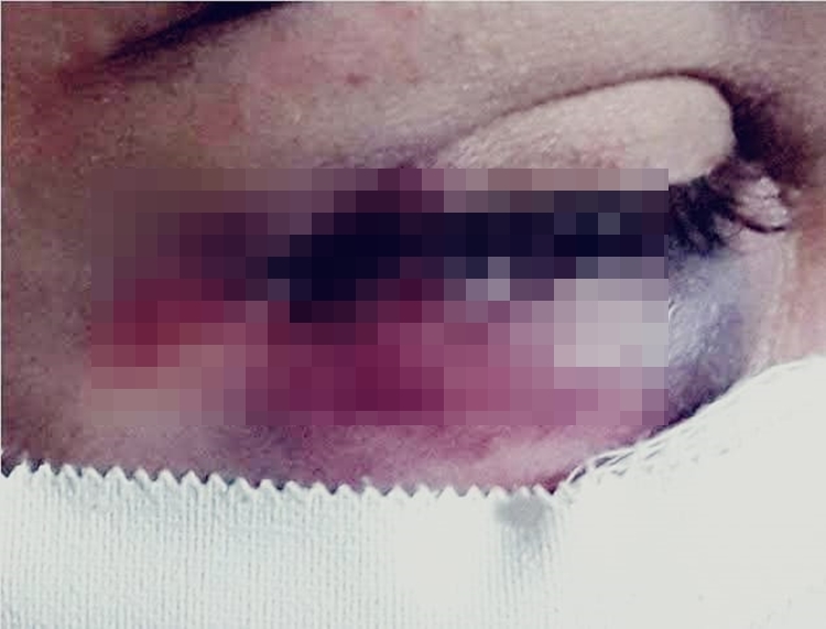 ROSTO DESFIGURADO: Dona de casa é surrada, mas por amor tenta impedir prisão do marido