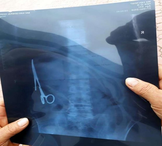 Homem
é operado para retirar tesoura esquecida há 18 anos