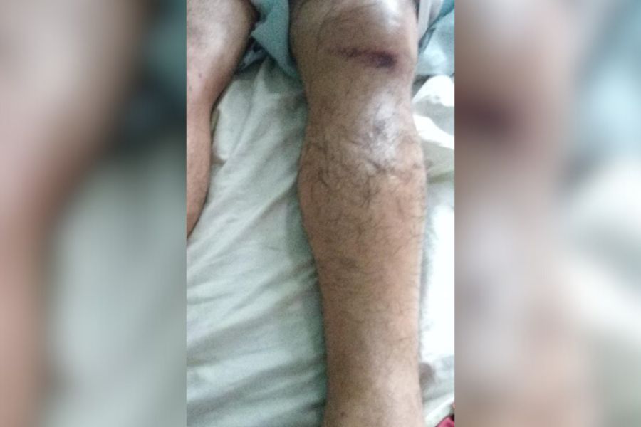 APELO: Após 16 dias de dor, exame particular revela fratura ignorada em atendimento público 