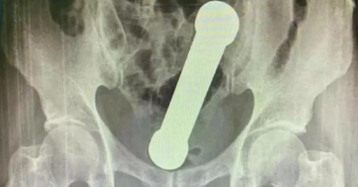 INUSITADO: Homem introduz halteres no ânus e vai parar no hospital