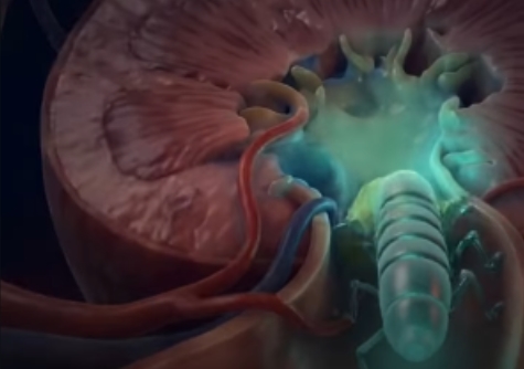 CANADENSE: Cientistas criam robô do tamanho de um grão de arroz que dissolve pedras nos rins