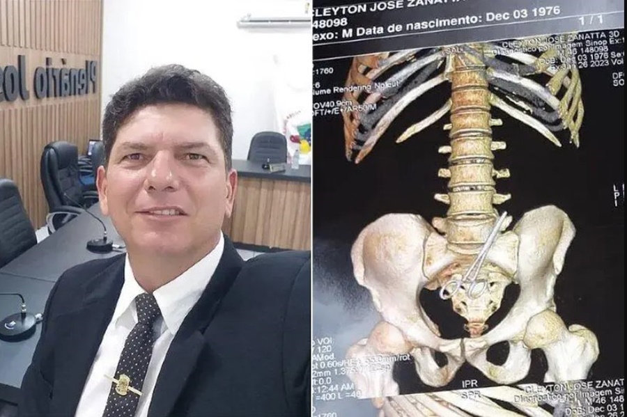 NEGLIGÊNCIA: Médicos esquecem tesoura dentro da barriga de vereador após cirurgia