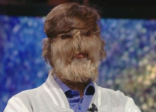 HIPERTRICOSE: Homem com 'síndrome do lobisomem' vira fenômeno na internet