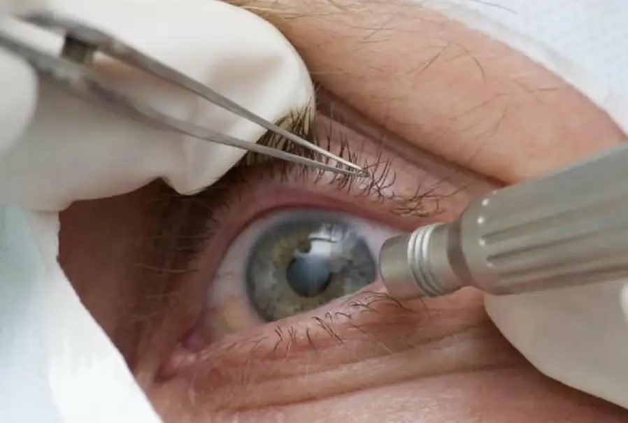 PERIGO: Médicos alertam para riscos de cirurgia de mudança da cor dos olhos