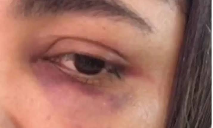 ACABOU PRESO: Técnica de enfermagem é espancada por marido que dormiu fora de casa