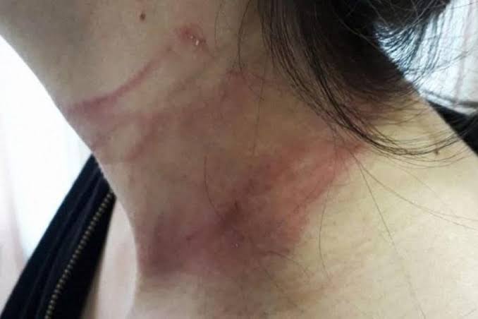 ESTRANGULADA: Mulher escapa de ser morta pelo ex-marido após intervenção de vizinhos