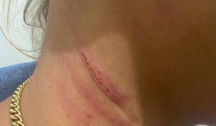 DEIXA SOLTO: Mulher é esfaqueada, mas não quer ver ex-namorado preso