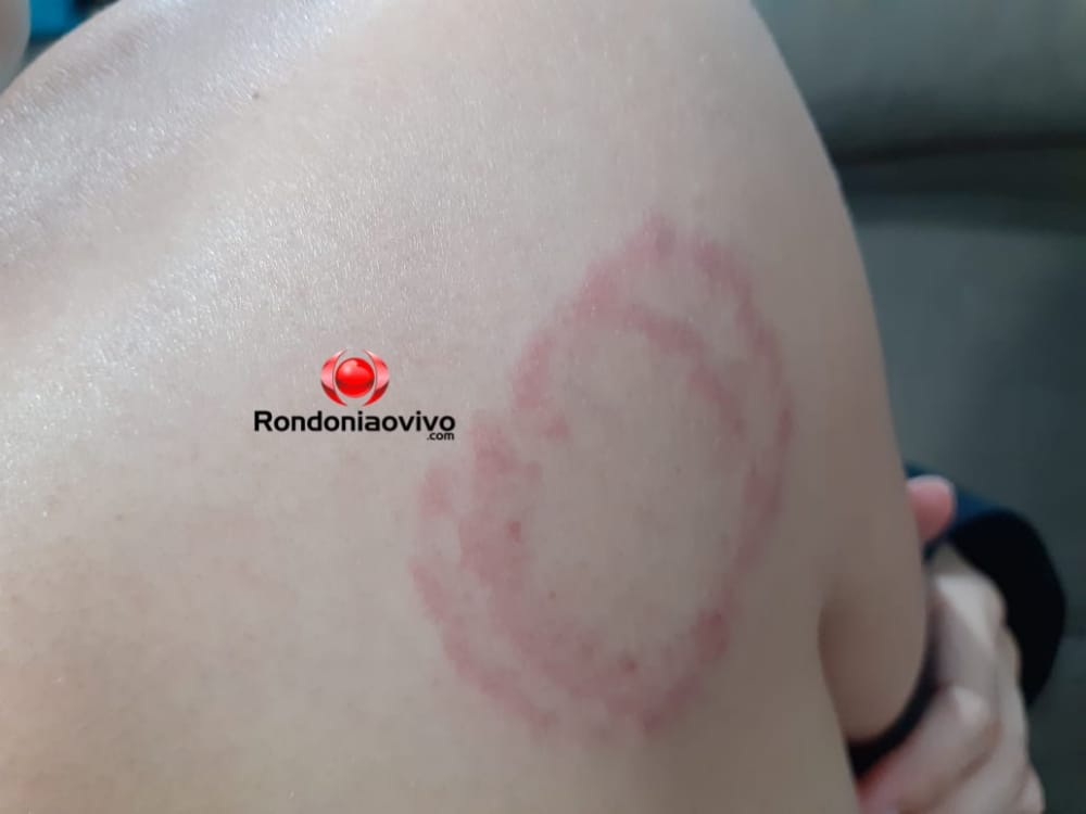 NÃO GOSTOU: Esposa é esfaqueada e atacada a mordidas por vomitar após bebedeira com marido