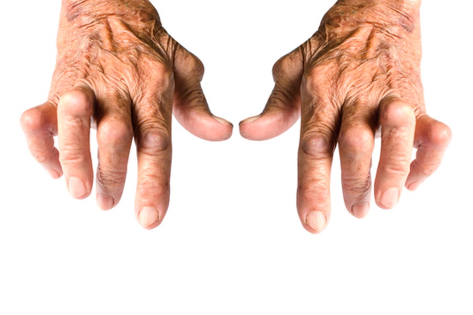SAÚDE E BEM ESTAR: Artrite suas causas, sintomas e tratamentos