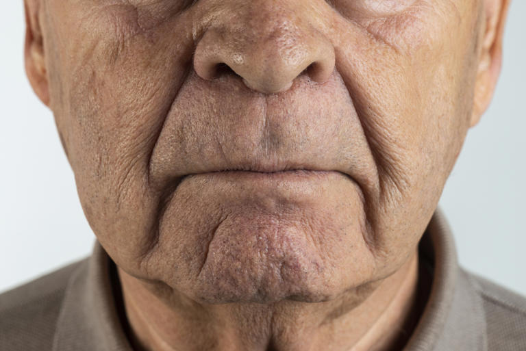 OBSERVE O OLFATO: Sinal de Parkinson que aparece muito antes dos sintomas clássicos 