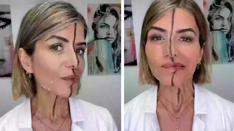 EFEITOS: Médica vira sua própria cobaia para mostrar efeito de botox 