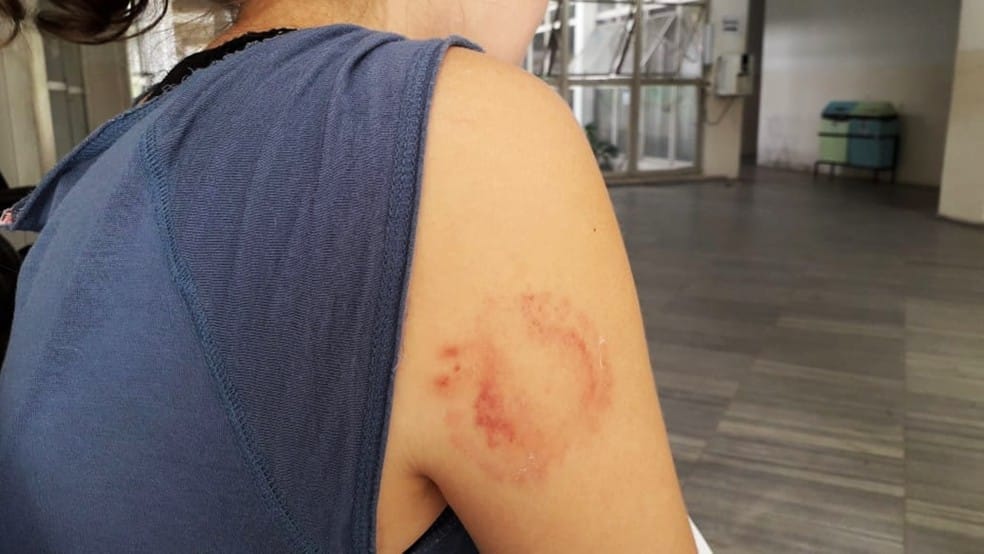 CIÚMES: Jovem é agredida com socos e mordidas pelo marido após bebedeira