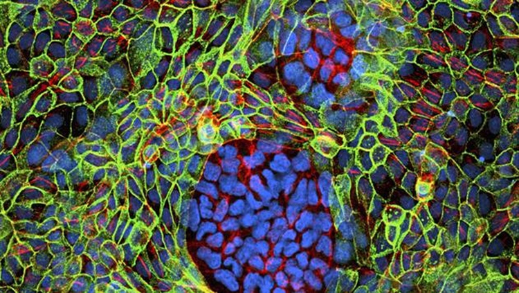 ESPERANÇA: Médicos creem em revolução no tratamento de câncer em menos de 30 anos