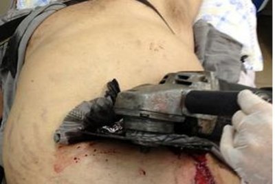 Acidente de trabalho deixa homem com serra cravada na barriga