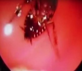 Mulher descobre que dor era causada por barata viva em sua cabeça