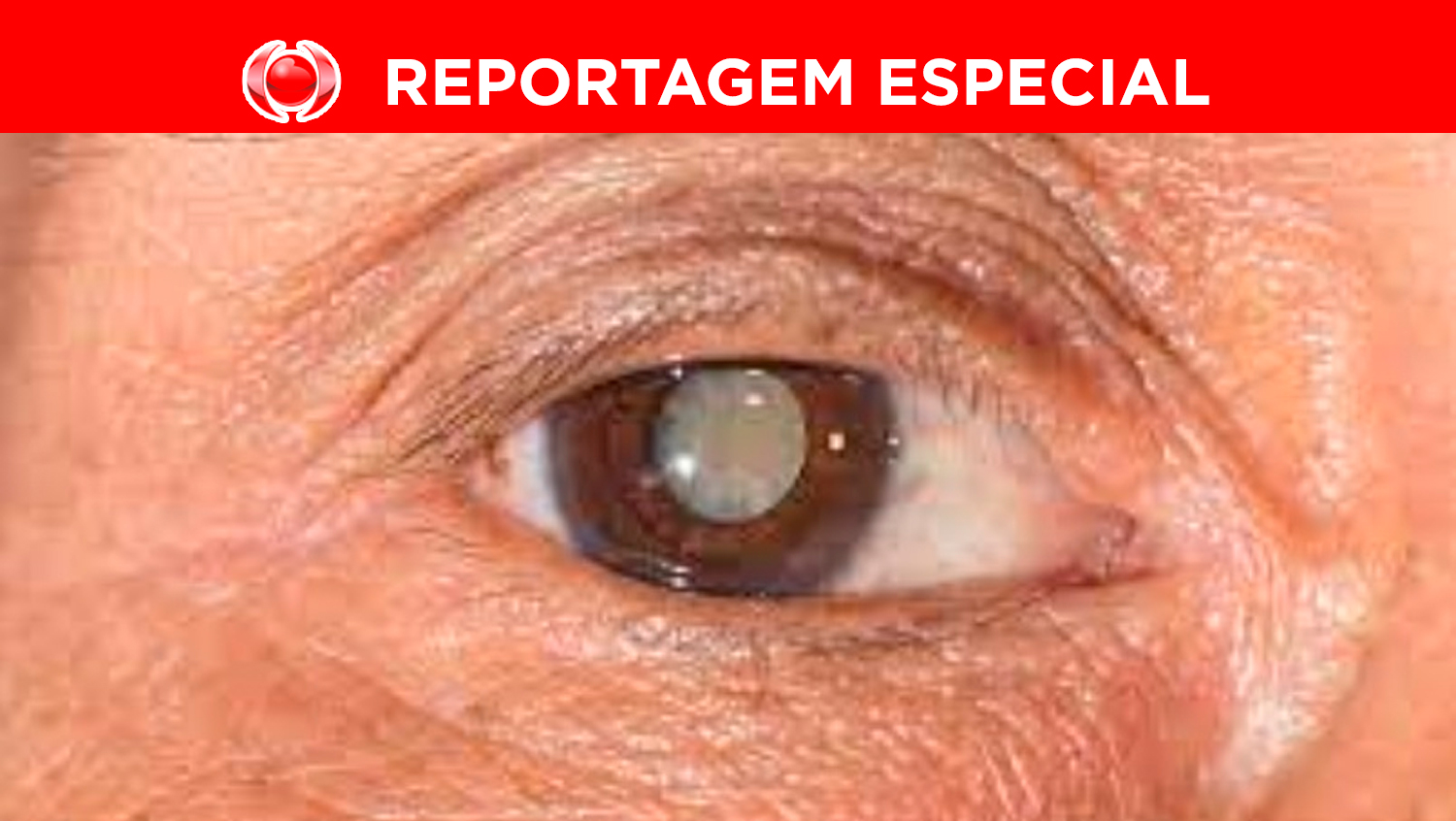 SAÚDE: Catarata atinge 39% das mulheres no Brasil, aponta IBGE