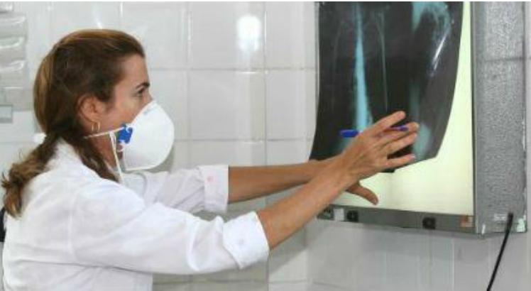 SUS vai adotar remédio para tuberculose que substitui três comprimidos por um