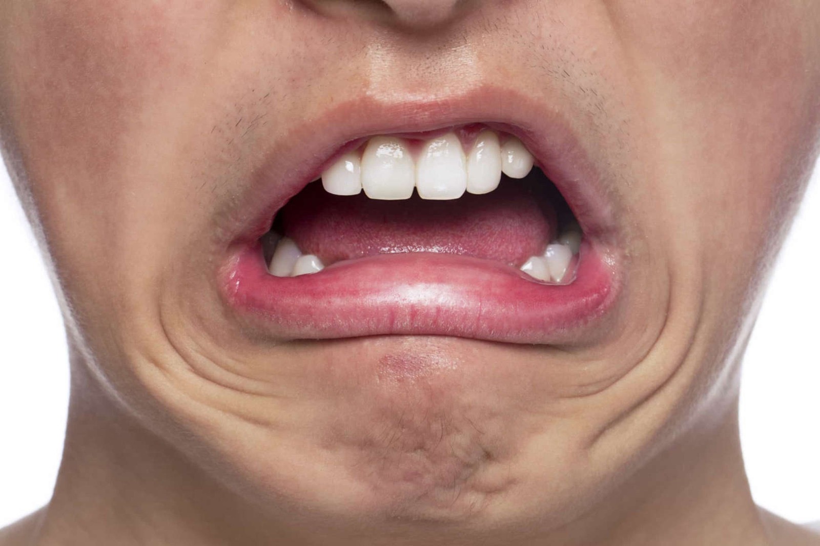 BOCA AZEDA: Como combater tanto desconforto o refluxo ácido e azia