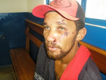 Buraco na Avenida causa grave acidente em trabalhador