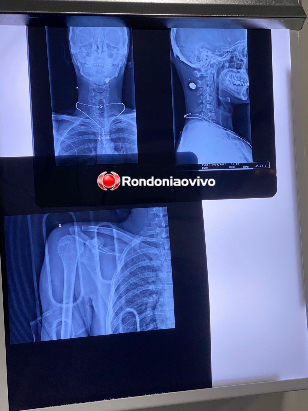 NA NUCA: Motociclista é vítima de bala perdida após tiroteio em Porto Velho