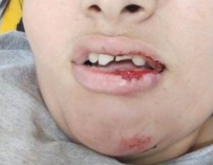 QUEDA BRUSCA: Motociclista fica banguela após acidente com gato em RO