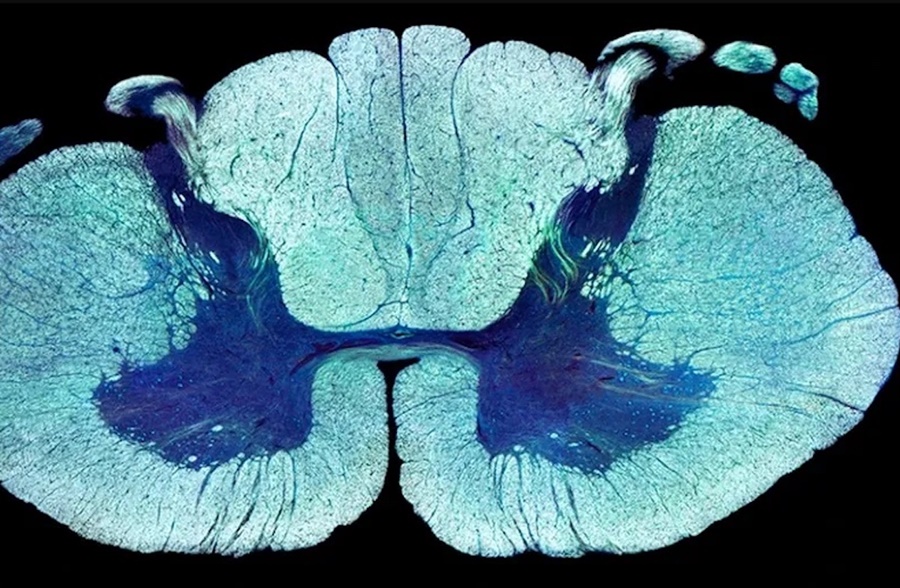 ESPERANÇA: Nove pessoas com paralisia voltaram a andar após receberem estimulação