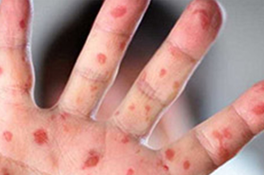 SARAMPO: Rondônia registra quatro anos sem casos da doença no estado