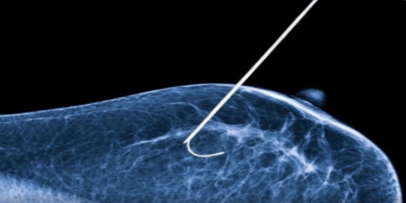 ESPERANÇA: Nova técnica de congelamento com nitrogênio é utilizada contra o câncer de mama