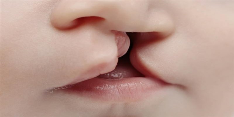 EM UM MÊS: Especialistas cobram tratamento rápido para fissura labiopalatina no SUS
